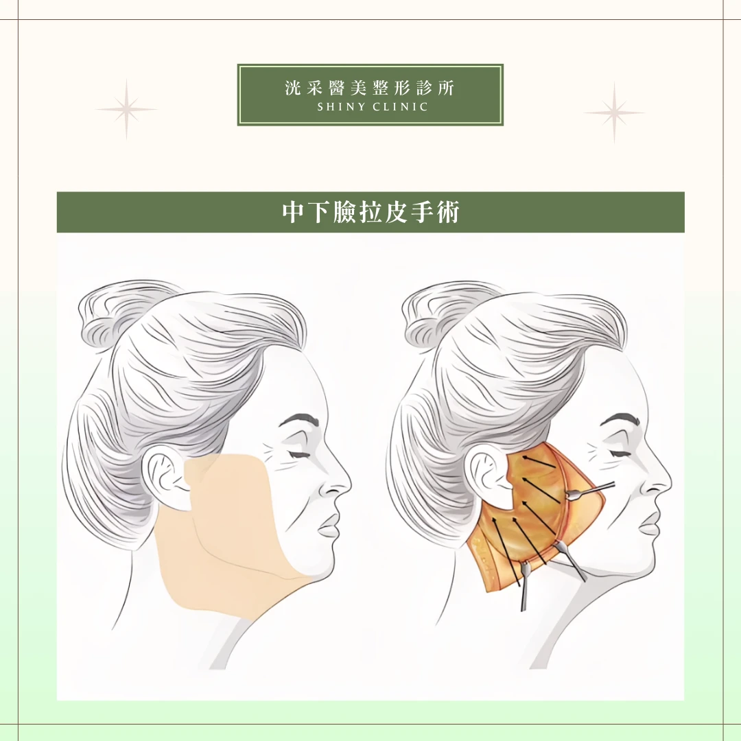 中下臉拉皮