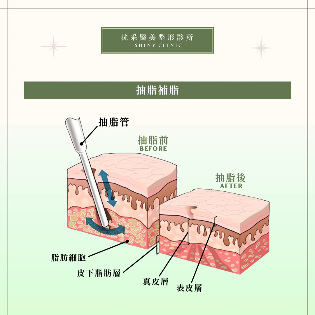 自體脂肪補脂