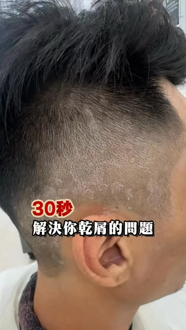 你是不是也受夠頭皮乾癢、頭皮屑的困擾？｜屏東健髮SPA｜屏東頭皮SPA