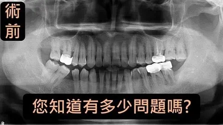 牙髓牙周合併症案例