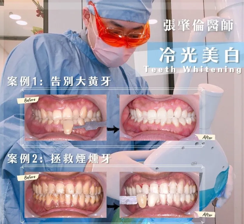 冷光美白