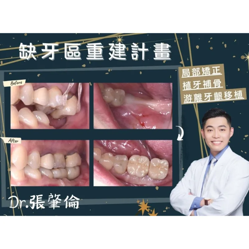 缺牙區重建(局部矯正/植牙補骨 /游離牙齦移植)