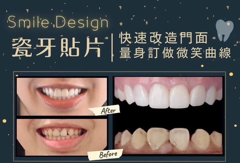 瓷牙美學  陶瓷貼片