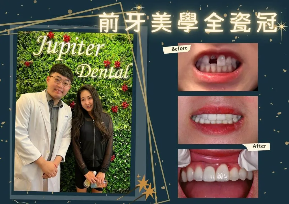 全瓷牙冠