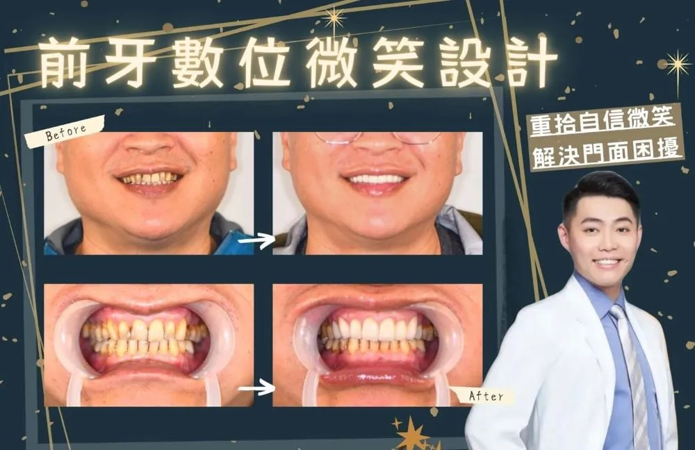 DSD數位微笑曲線設計Digital Smile Design
