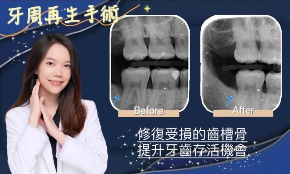 牙周再生手術