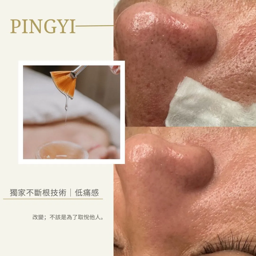 ｜粉刺手藝｜毛孔極淨｜ “改變不為誰，只為照鏡子那一刻，能多愛自己一點。”