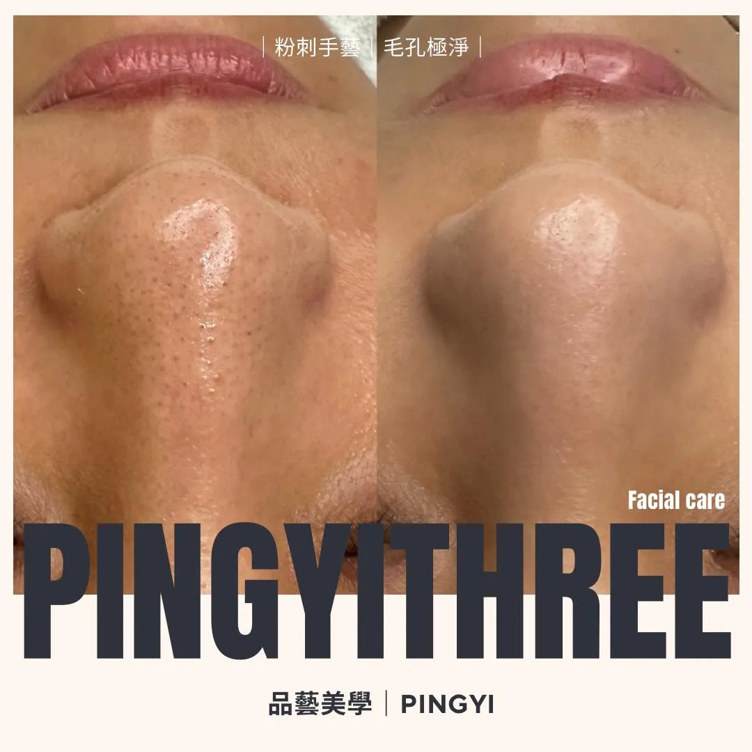 粉刺手藝｜毛孔極淨｜
