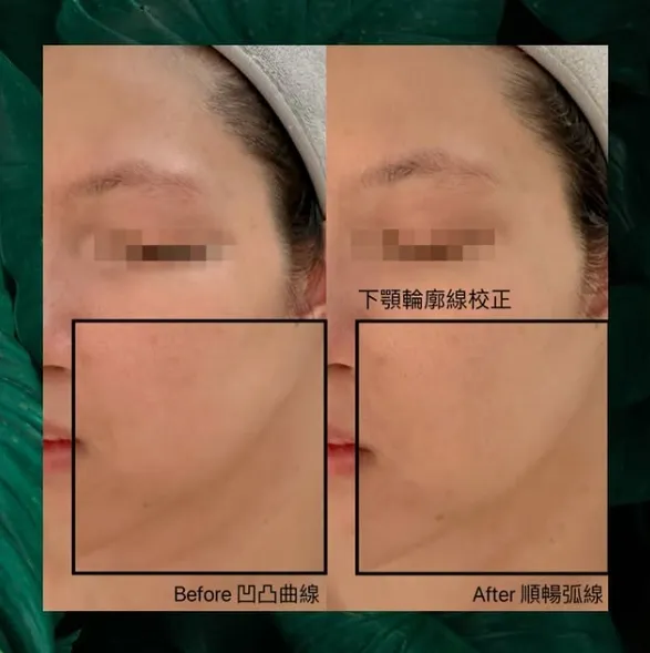 美容前後對比照