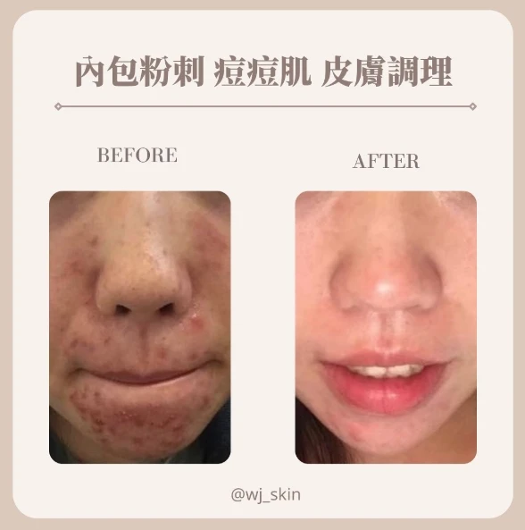 內包粉刺 痘痘肌 皮膚調理