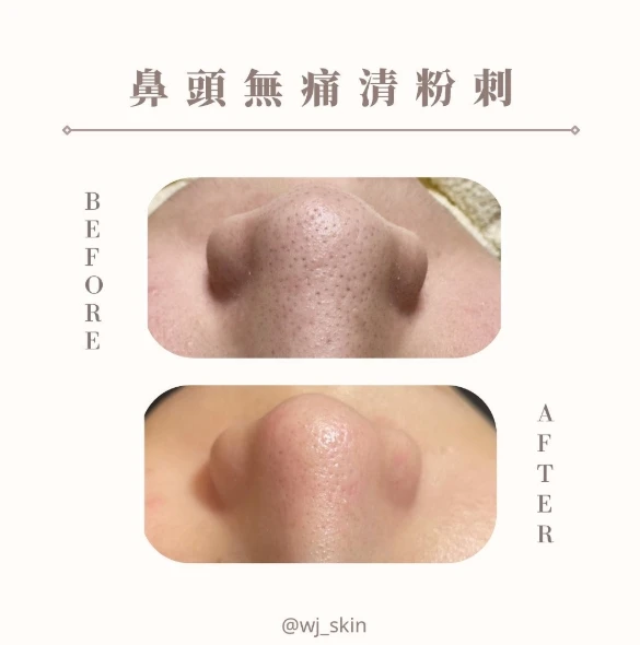 鼻頭無痛清粉刺