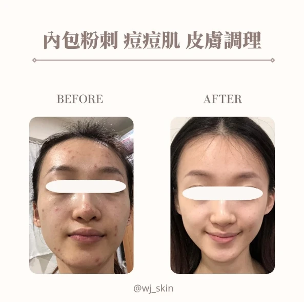 內包粉刺 痘痘肌 皮膚調理