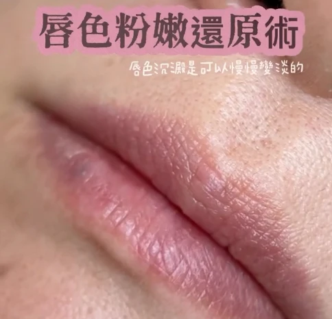 唇色沉澱，可以慢慢淡掉的- 新竹唇色還原｜竹北無痛唇色還原