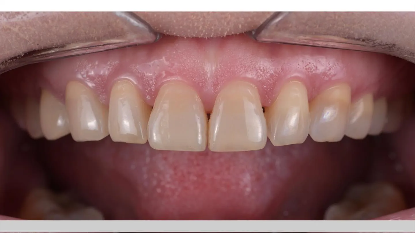 12.13.14 氧化鋯燒瓷 & 全鋯冠