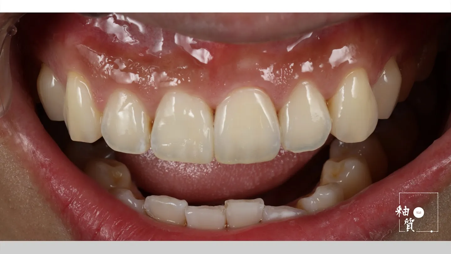 21 zirconia layering
