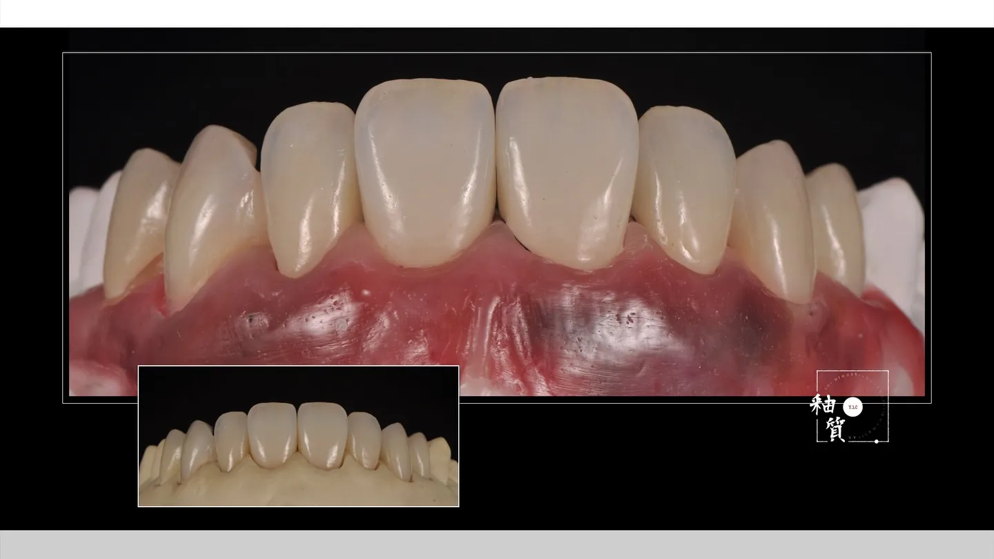 14-24  氧化鋯 燒瓷&染色