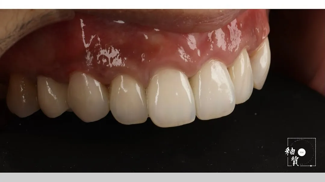 唇側燒瓷 - labial side layering & stain 14-24