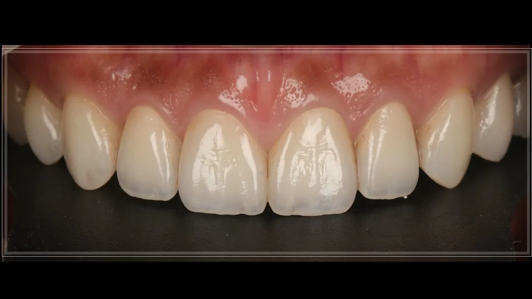 13-25 crown & veneer  layering