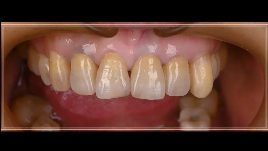 - 唇側燒瓷  - 那些修改的事