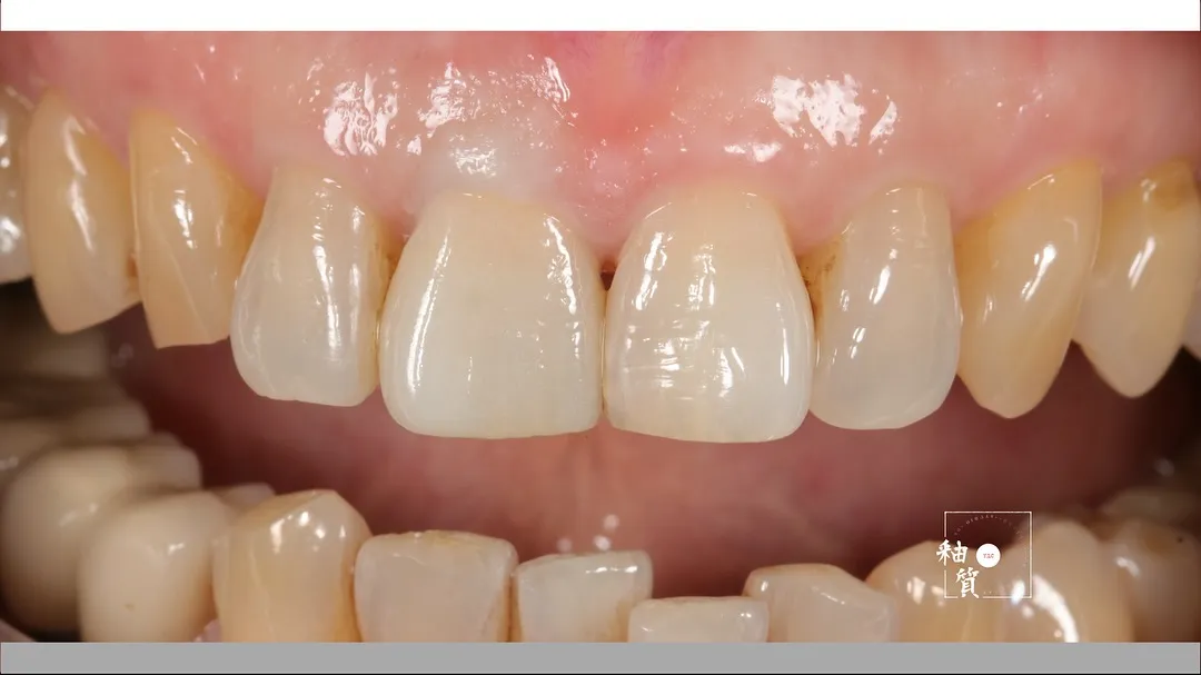 - zirconia layering  - 唇側燒瓷