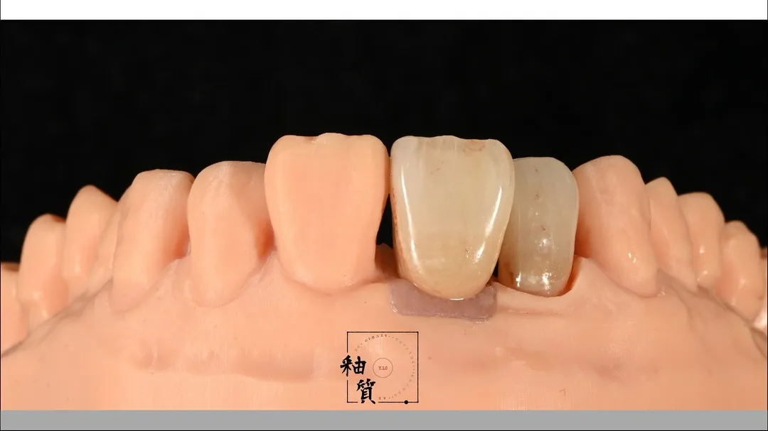 數位製程 - 12。11 labial side layering & stain