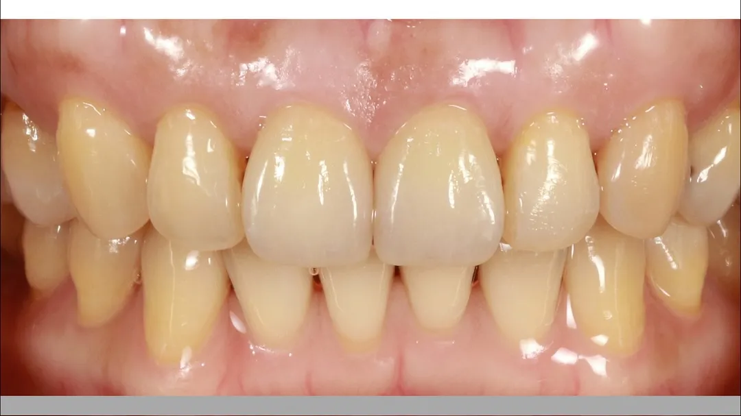 11 & 21 veneer layering