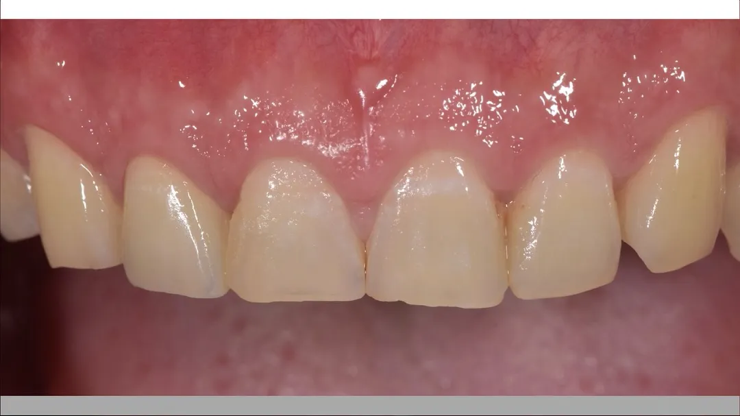 12 labial side layering