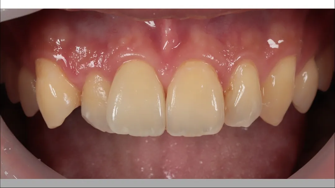 - zirconia layering  - 11 Labial side