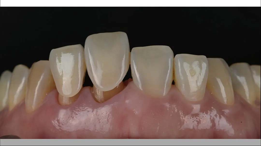 labial side layering