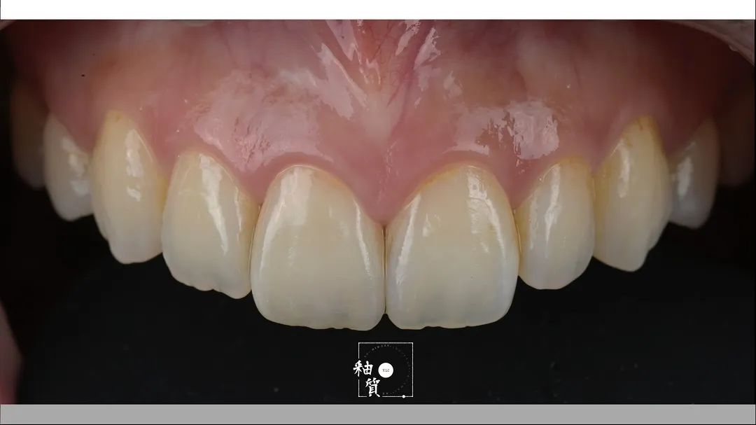 11 zirconia layering - 專注於每個細節的匠心精神