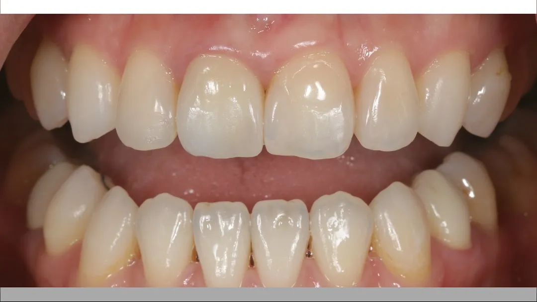 11 zirconia layering