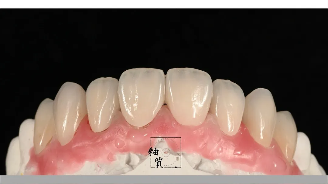 4-4 zirconia layering - 一個非常接近美白牙的案例