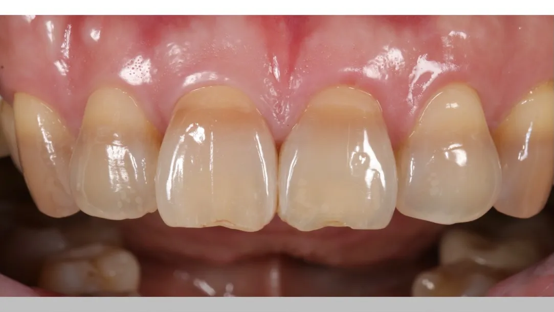 labial side layering 唇側燒瓷