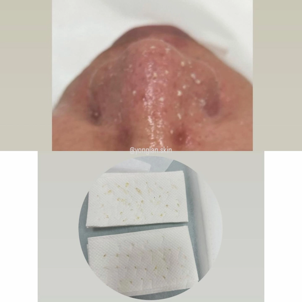 水飛梭｜北屯區粉刺清潔