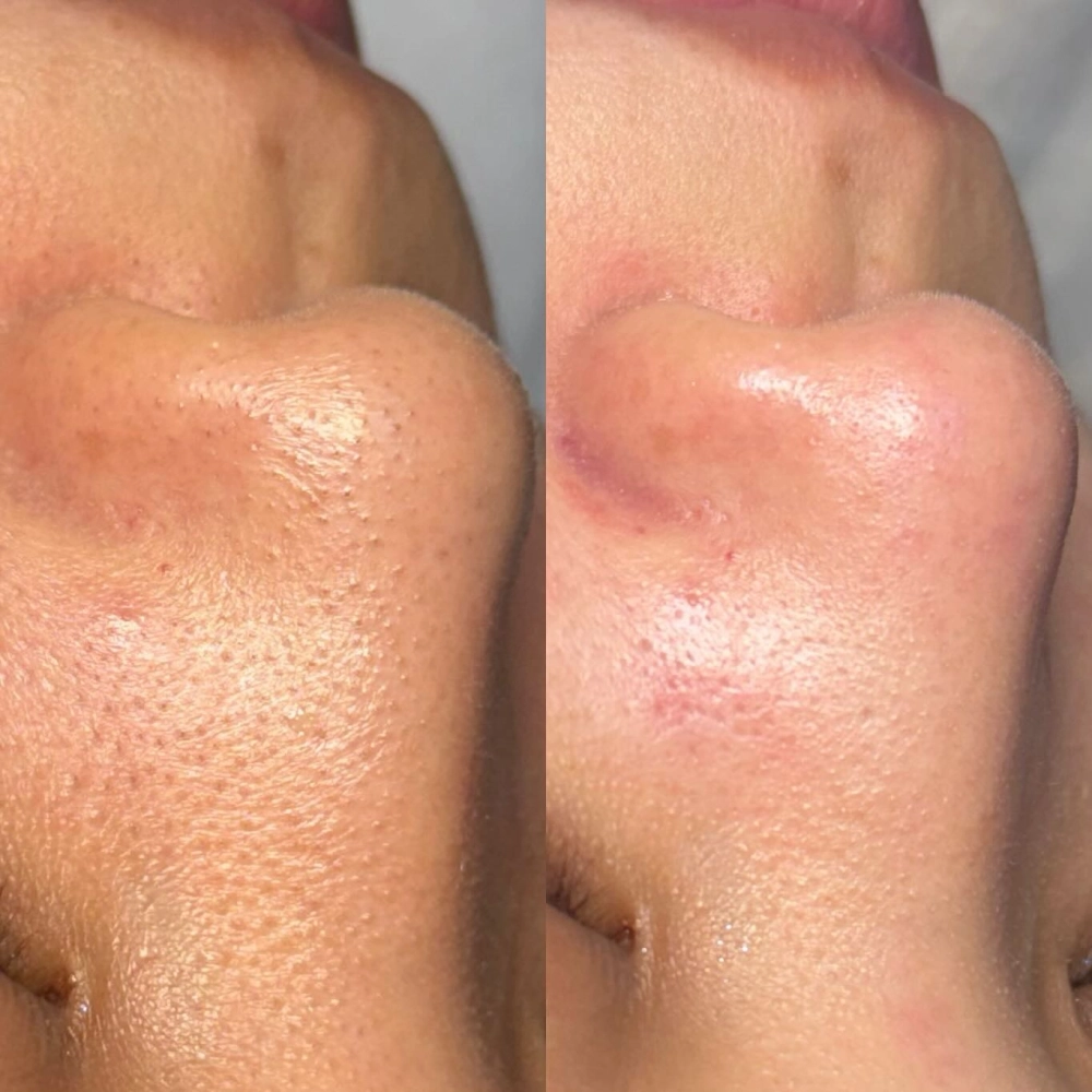 水飛梭｜北屯區粉刺清潔