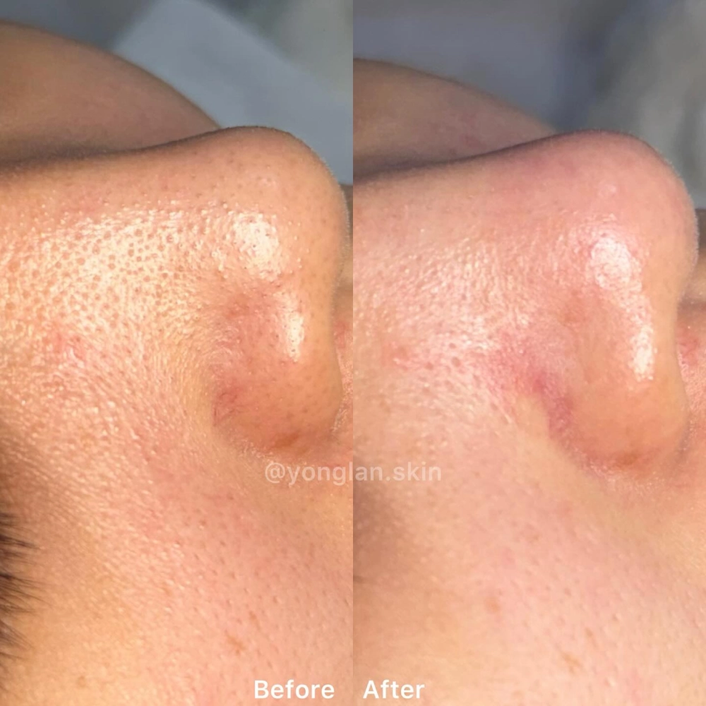 水飛梭｜北屯區粉刺清潔