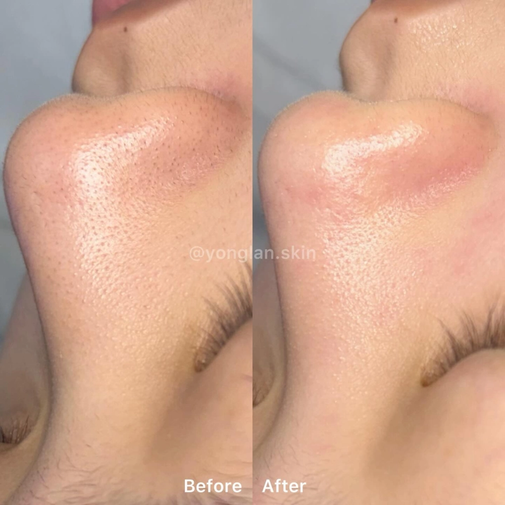 水飛梭｜北屯區粉刺清潔