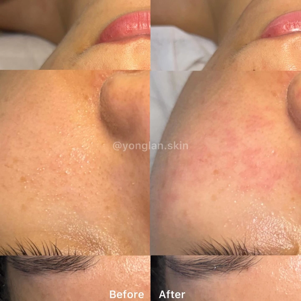 B5精華注氧補水｜北屯區做臉