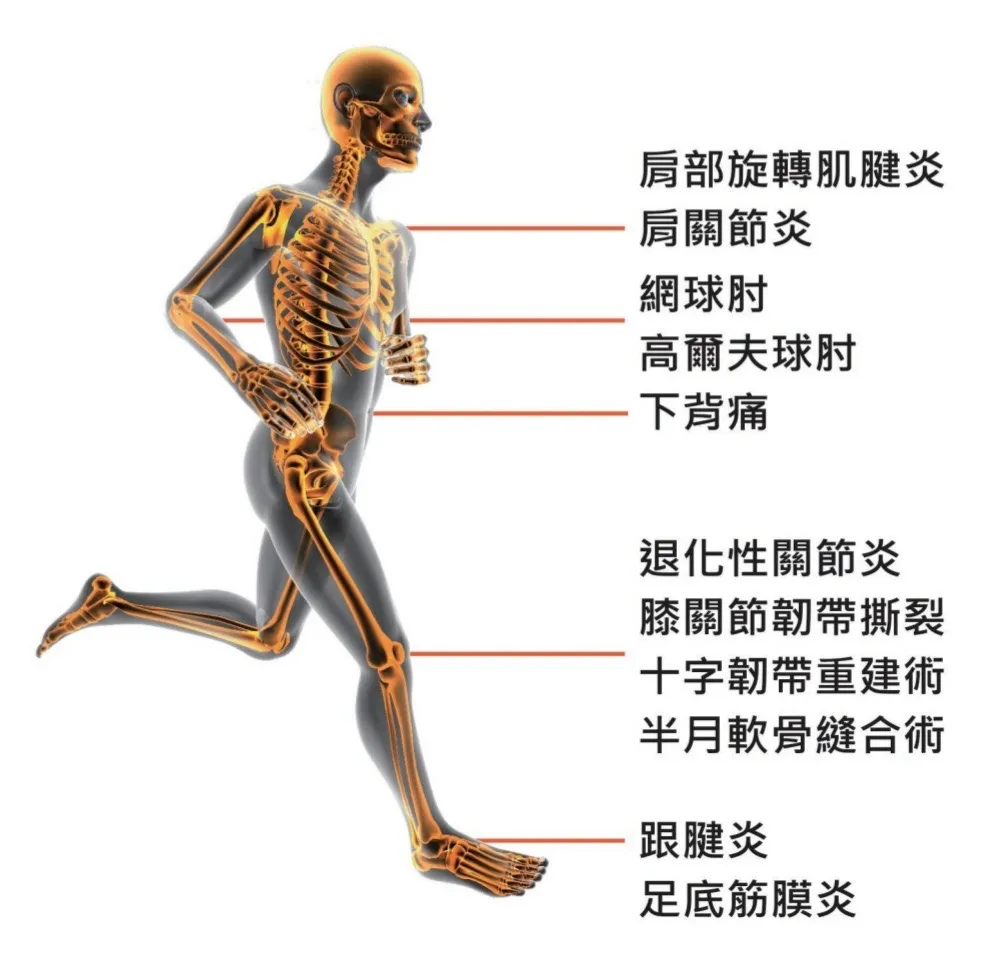 06. 骨震波治療